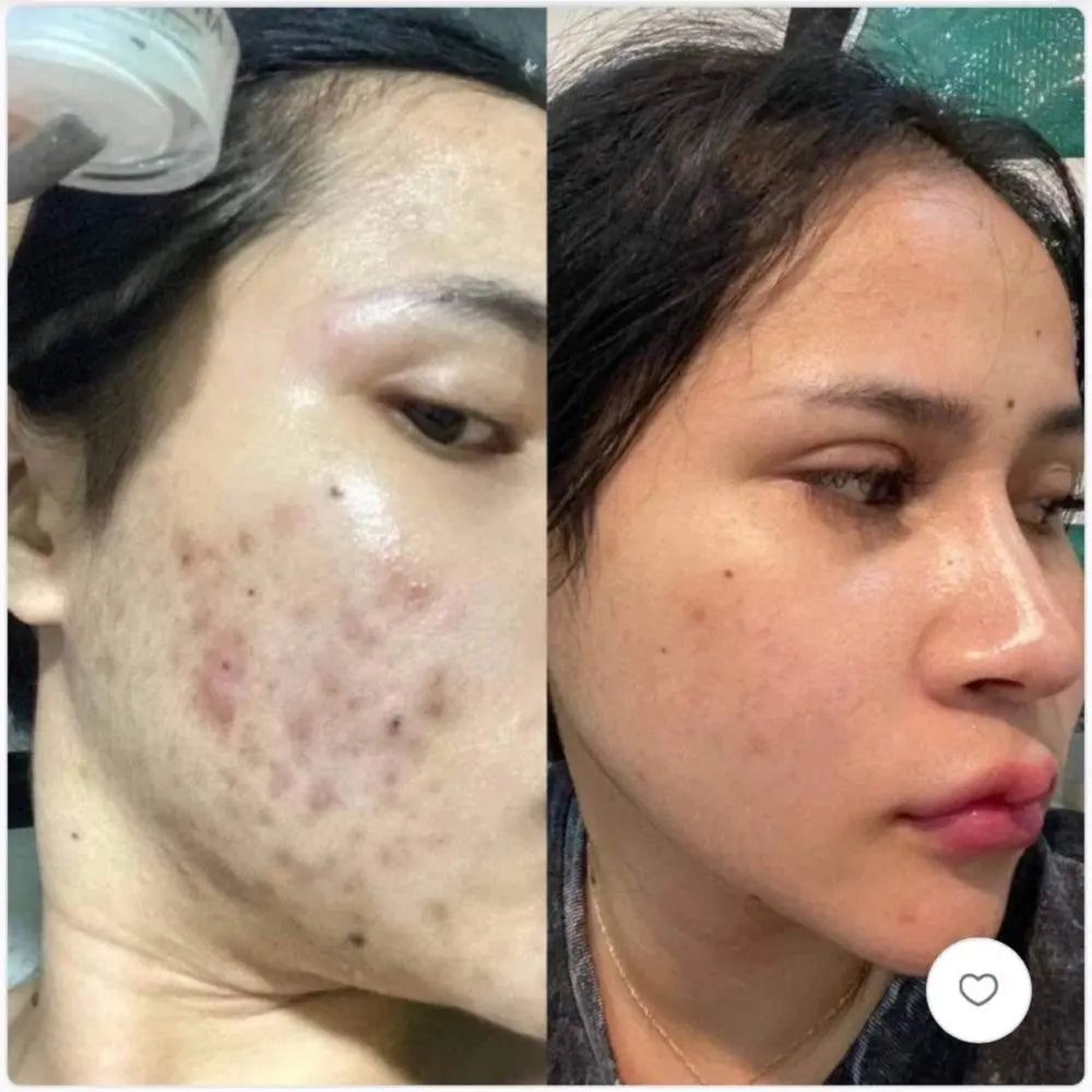 Before and after comparison of a person's face with visible acne on the left, and clearer skin on the right.