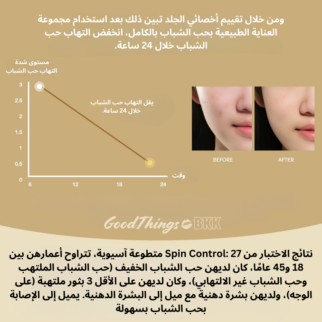 Oriental Princess Natural Acne Care Treatment Serum / سيروم علاج حب الشباب من أورينتال برنسيس